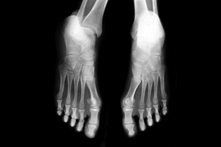 understanding-foot-stress-fractures